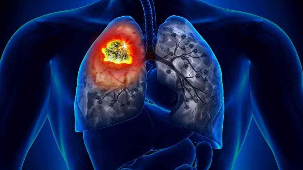 Cancer de Pulmão Mitos e verdades sobre o câncer de pulmão: desmistificando o tratamento - 6092ff45720873cc0c2dfcd0 cancer de pulmao