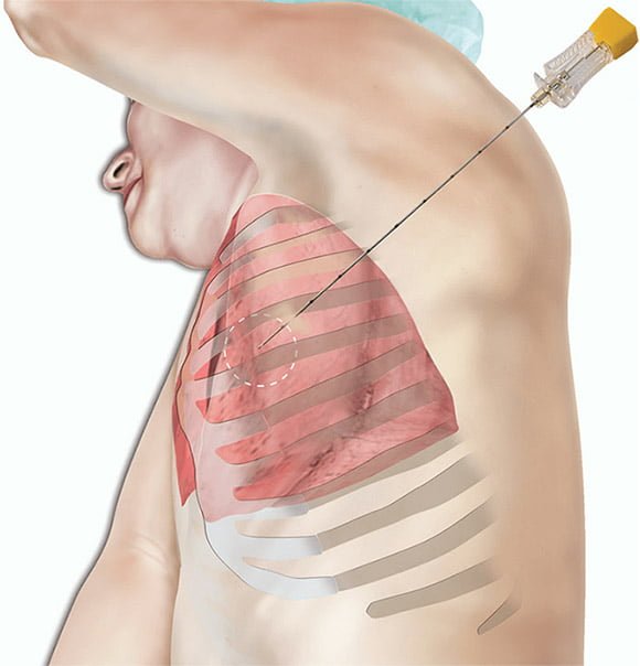Biópsia de tórax - biópsia percutânea guiada TC 1 Biópsia de tórax - biópsia percutânea guiada TC - biopsia percutaneas