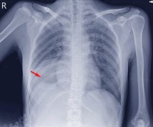 derrame pleural - Tratamentos