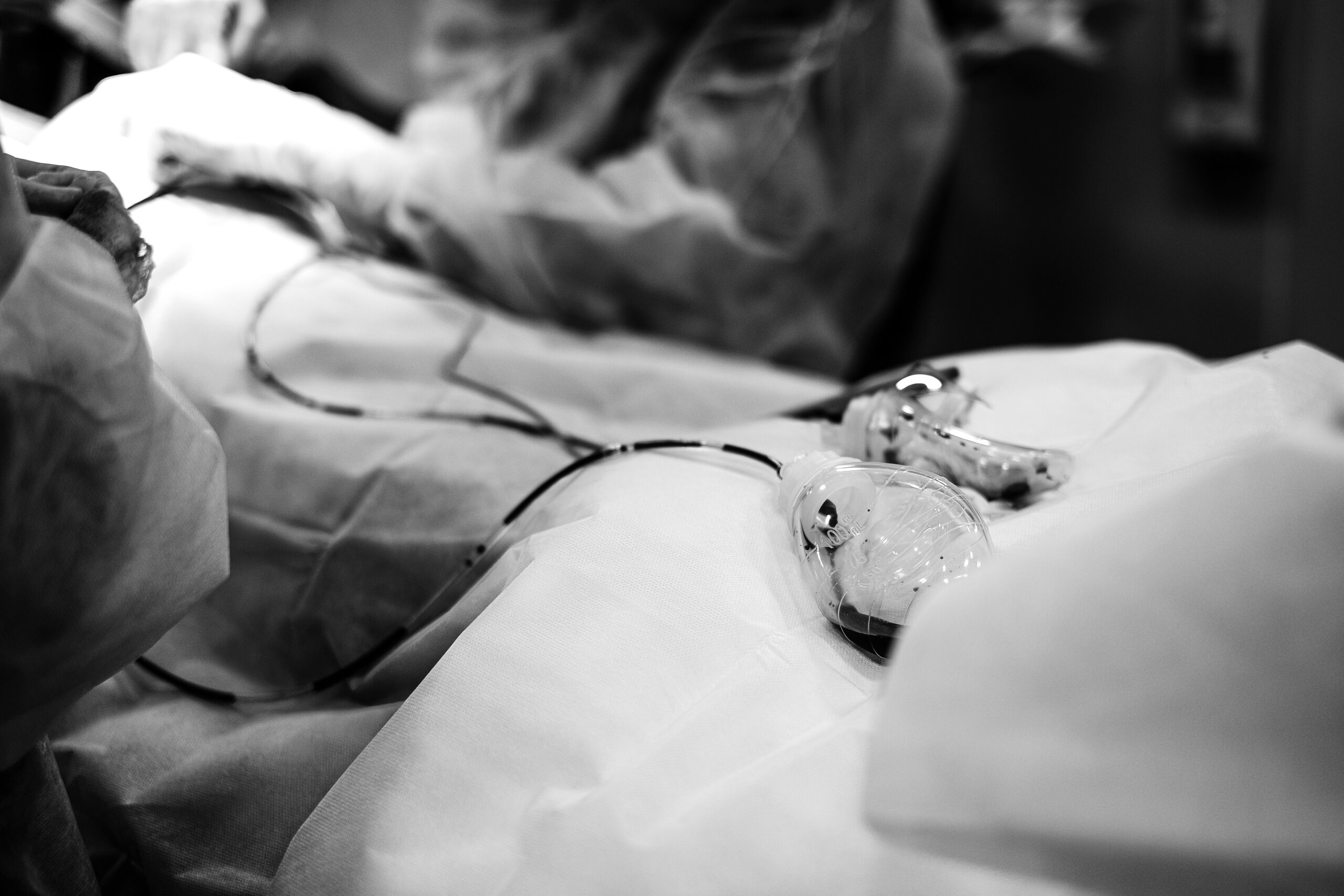 Pleurodese por vídeo (VATS) para derrame pleural