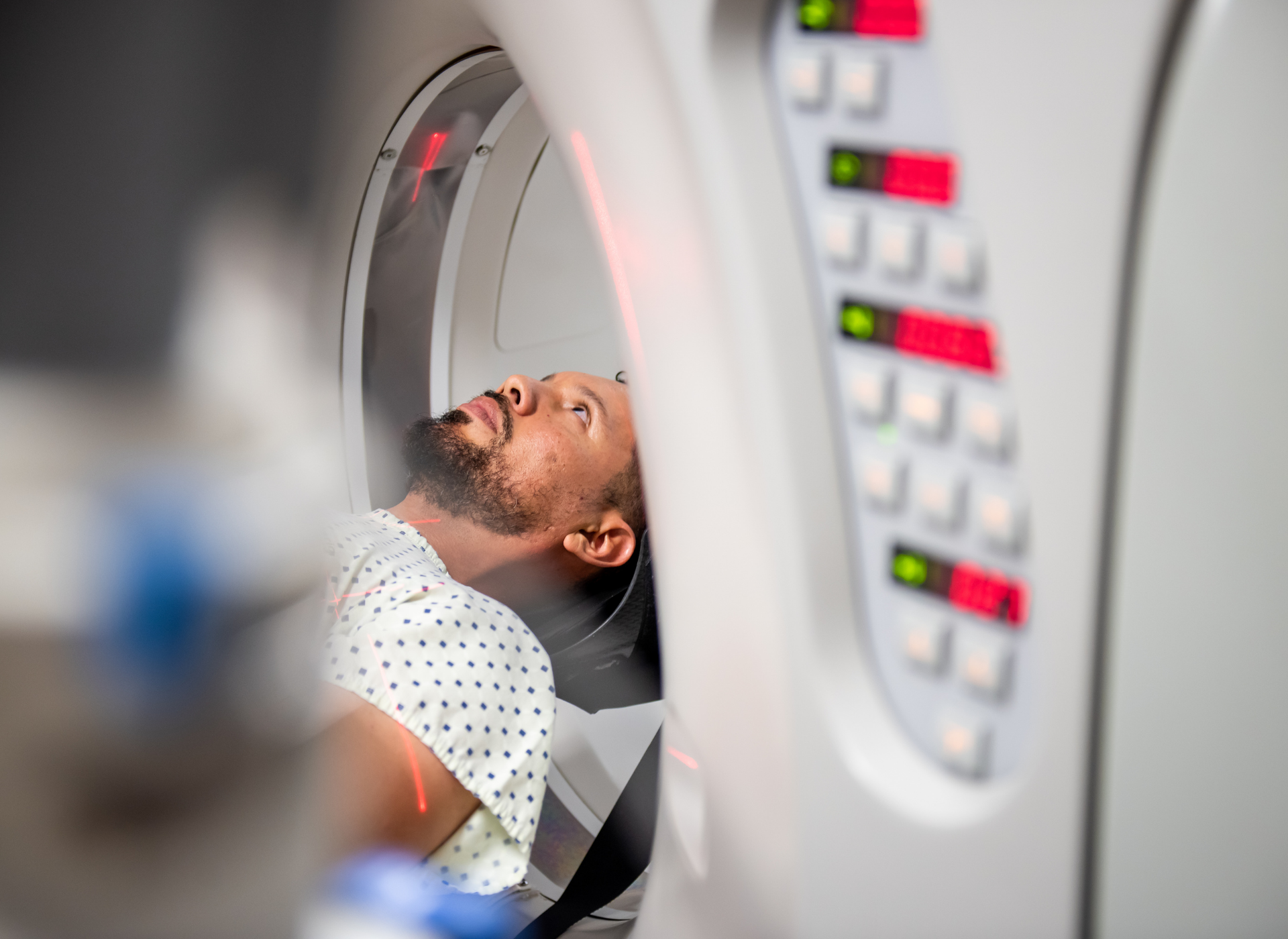 Biópsia pulmonar guiada por TC: diagnóstico preciso e minimamente invasivo 3 Biópsia pulmonar guiada por TC: diagnóstico preciso e minimamente invasivo