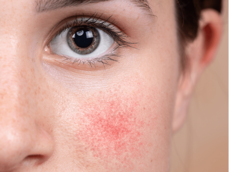 Rubor facial tratado com simpatectomia torácica - rubor facil tratamento