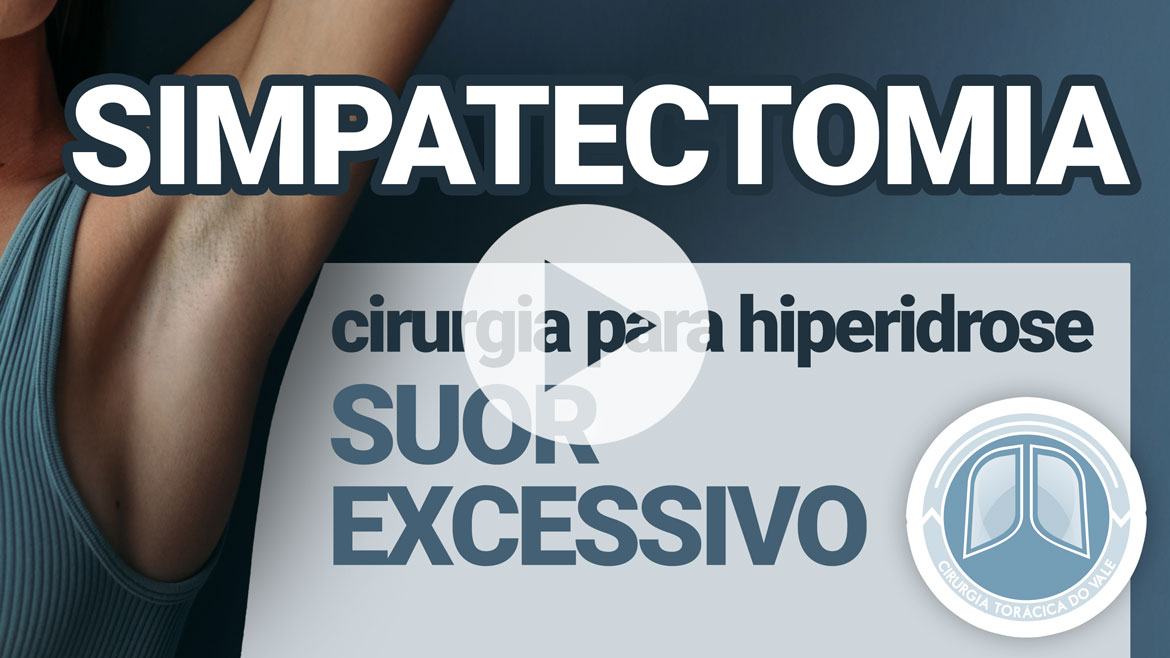 simpatectomia_video1170 Rubor facial e hiperidrose: tratamento definitivo com precisão cirúrgica - simpatectomia video1170